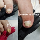 Лечение вросшего ногтя скобами