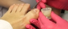 Протезирование при вросшем ногте