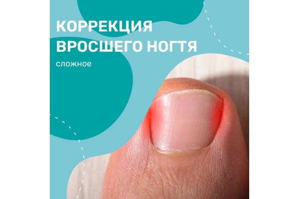 Коррекция вросшего ногтя (сложное)