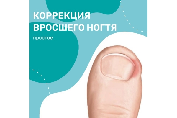 Коррекция вросшего ногтя (простое)