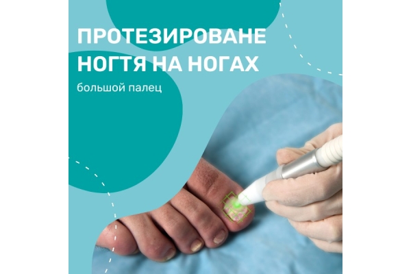 Протезирование ногтя на ногах (большой палец)