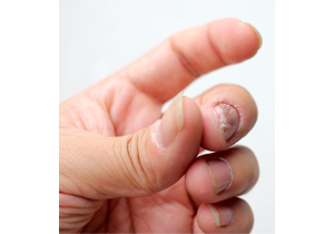Лечение грибка ногтей на руках