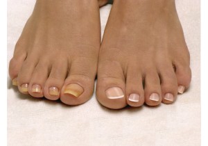 Лечение грибка ногтей на большом пальце