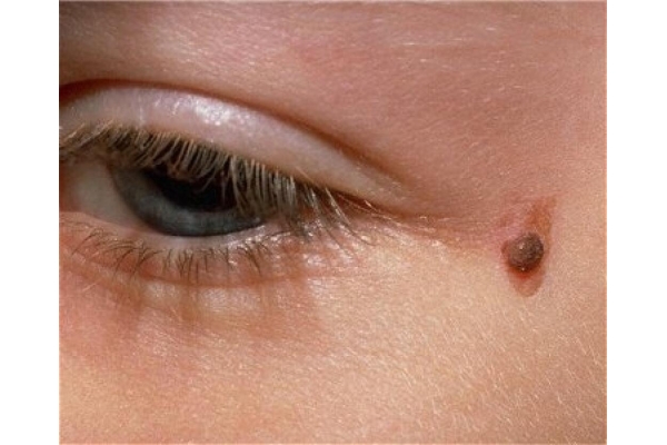 Удаление доброкачественных новообразований кожи (НЕВУСЫ)  на лице,шее.голове - 1 мм.
