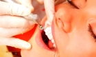 Снятие зубного налета и полировка зубов (1 зуб)