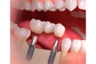 Установка имплантов зубов