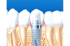 Установка импланта на 1 зуб