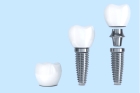 Установка корейского импланта зуба под ключ