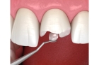 Эстетическая реставрация одного зуба (центральной группы)