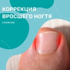 Коррекция вросшего ногтя (сложное)