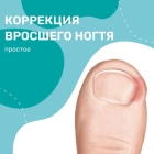 Коррекция вросшего ногтя (простое)