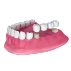 Зубной мост 4 зуба 