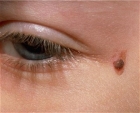 Удаление доброкачественных новообразований кожи (НЕВУСЫ)  на лице,шее.голове - 1 мм.