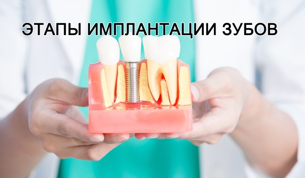 Как делают импланты зубов (этапы имплантации)